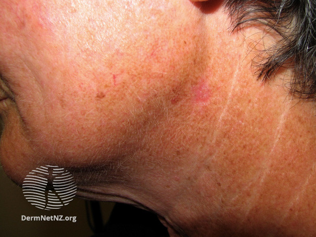 Basal cell carcinoma affecting the face (DermNet NZ lesions-bcc-face-0680).jpg