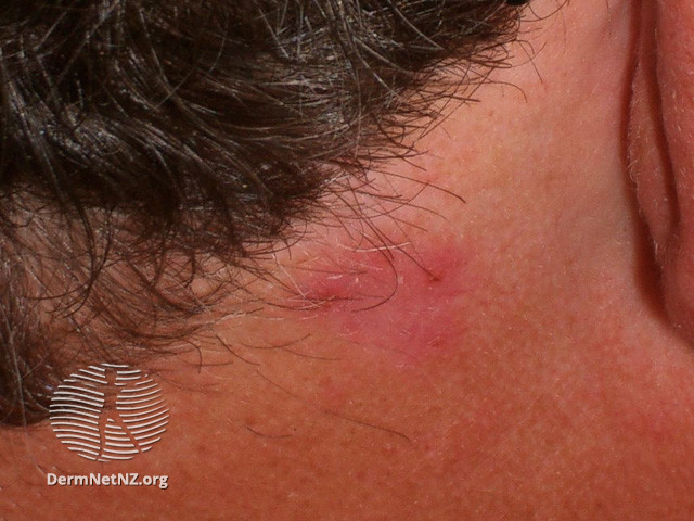File:Basal cell carcinoma affecting the face (DermNet NZ lesions-bcc-face-1006).jpg