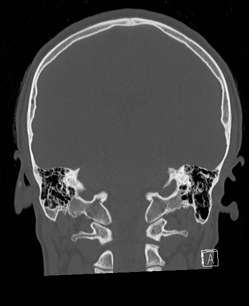 Base of skull fracture with bilateral Le Fort fractures (Radiopaedia 47094-51638 Coronal bone window 38).jpg