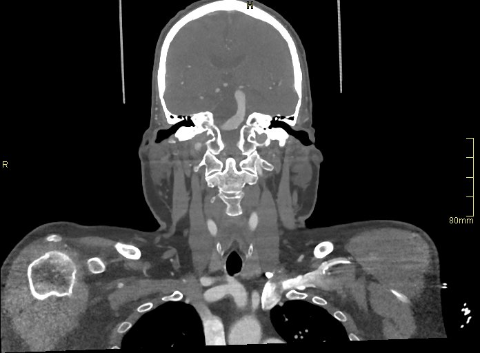Basilar artery aneurysm (Radiopaedia 56261-62932 B 25).jpg