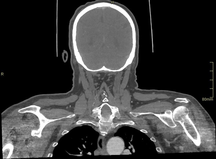 Basilar artery aneurysm (Radiopaedia 56261-62932 B 57).jpg