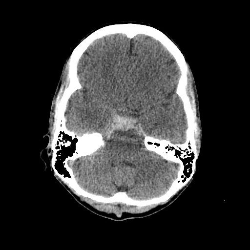 File:Basilar artery perforator aneurysm (Radiopaedia 82455-96597 Axial non-contrast 10).jpg