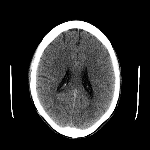 File:Basilar artery perforator aneurysm (Radiopaedia 82455-96597 Axial non-contrast 22).jpg