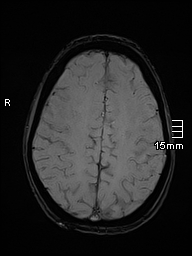 File:Basilar artery perforator aneurysm (Radiopaedia 82455-99523 Axial SWI 49).jpg