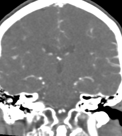Basilar tip aneurysm with coiling (Radiopaedia 53912-60086 B 87).jpg