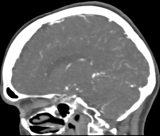 Basilar tip aneurysm with coiling (Radiopaedia 53912-60086 C 78).jpg