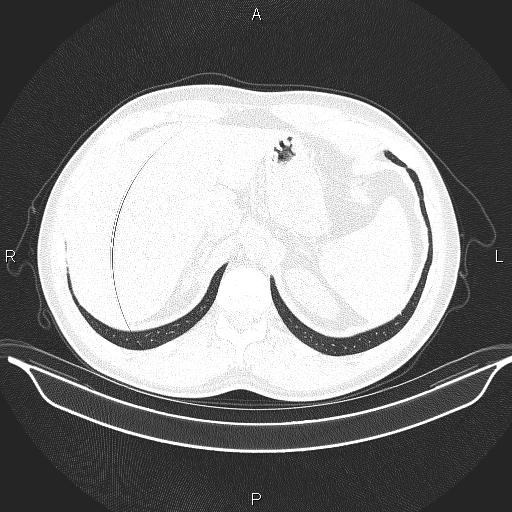 File:Beam hardening and ring artifacts (Radiopaedia 85323-100915 Axial lung window 70).jpg