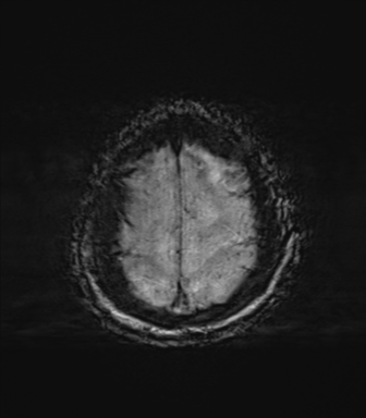 File:Behavioral variant frontotemporal dementia and late onset schizophrenia (Radiopaedia 52197-58083 Axial SWI 72).png
