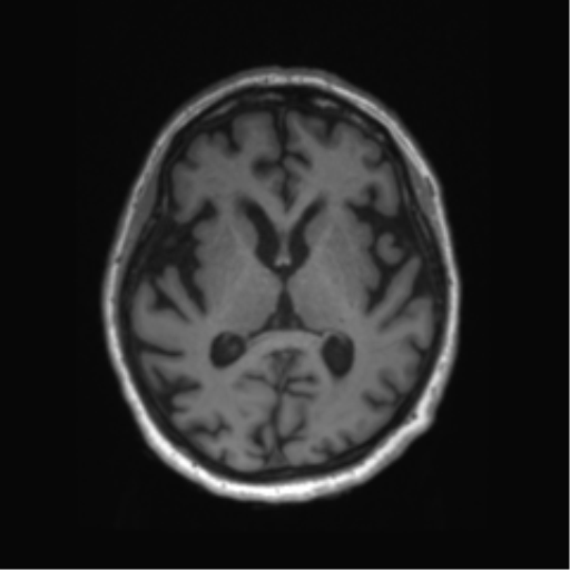 Behavioral variant frontotemporal dementia and late onset schizophrenia (Radiopaedia 52197-58083 Axial T1 49).png