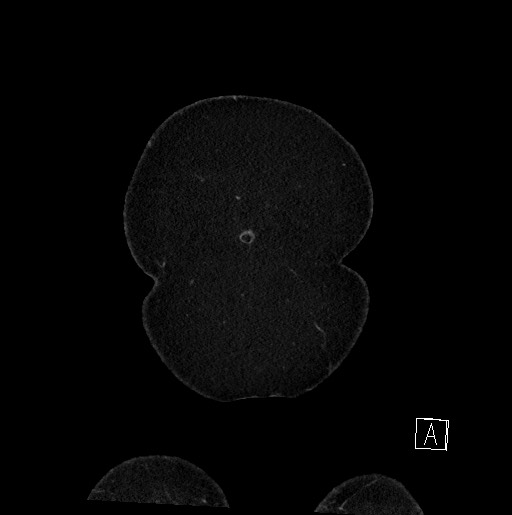 Below filter IVC thrombosis (Radiopaedia 58187-65266 B 16).jpg