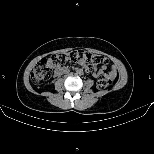 Benign adrenal adenoma (Radiopaedia 84166-99440 Axial non-contrast 56).jpg