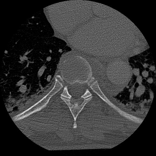 Benign post-traumatic pseudopneumoperitoneum (Radiopaedia 71199-81495 Axial bone window 114).jpg