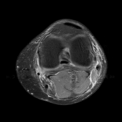 File:Biceps femoris distal tendon avulsion (Radiopaedia 15109-14987 Axial PD fat sat 14).jpg