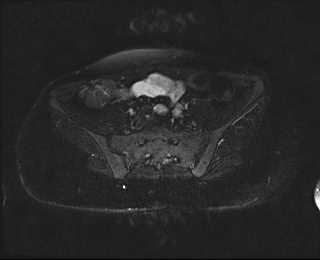 File:Bicornuate bicollis uterus (Radiopaedia 61626-69616 Axial PD fat sat 7).jpg