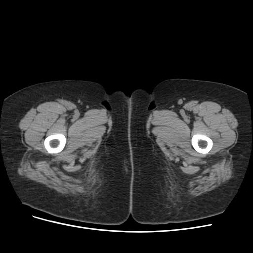 File:Bicornuate uterus (MRI) (Radiopaedia 49206-54296 Axial 18).jpg