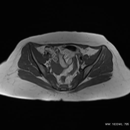 File:Bicornuate uterus (MRI) (Radiopaedia 49206-54297 Axial 15).jpg