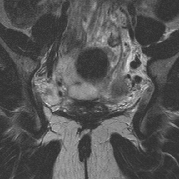 File:Bicornuate uterus (Radiopaedia 24677-24949 Coronal T2 13).jpg