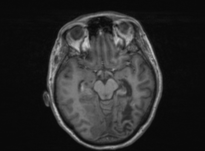 Bilateral PCA territory infarction - different ages (Radiopaedia 46200-51784 Axial T1 264).jpg