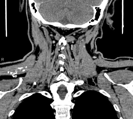 File:Bilateral Warthin tumors (Radiopaedia 84034-99263 C 42).jpg