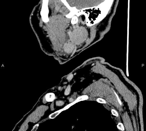 Bilateral Warthin tumors (Radiopaedia 84034-99263 D 63).jpg