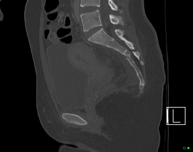 Bilateral acetabular fractures (Radiopaedia 79272-92308 Sagittal bone window 47).jpg