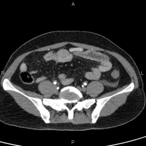 File:Bilateral adrenal gland hyperenhancement in pancreatitis (Radiopaedia 86642-102753 B 96).jpg