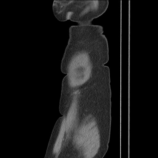 File:Bilateral adrenal granulocytic sarcomas (chloromas) (Radiopaedia 78375-91007 C 19).jpg