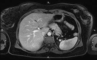Bilateral adrenal myelolipoma (Radiopaedia 63058-71537 G 27).jpg