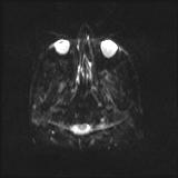 Bilateral basal ganglia and thalamic T1 hyperintensities (Radiopaedia 19764-19802 Axial DWI 1).jpg