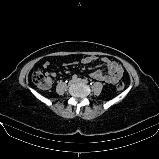 Bilateral benign adrenal adenomas (Radiopaedia 86912-103124 Axial C+ delayed 103).jpg