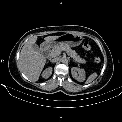 Bilateral benign adrenal adenomas (Radiopaedia 86912-103124 Axial non-contrast 39).jpg