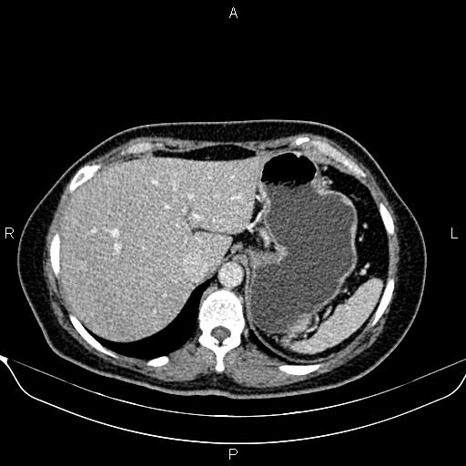 Bilateral benign adrenal adenomas (Radiopaedia 86912-103124 B 24).jpg
