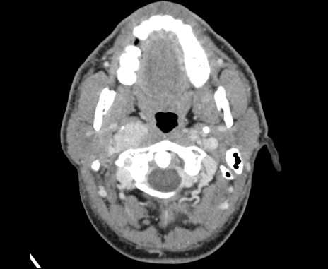 Bilateral carotid body tumors (Radiopaedia 61841-69870 Axial Post contrast 21).jpg