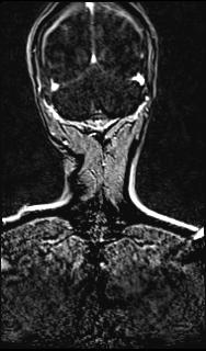 File:Bilateral carotid body tumors and right jugular paraganglioma (Radiopaedia 20024-20060 None 167).jpg