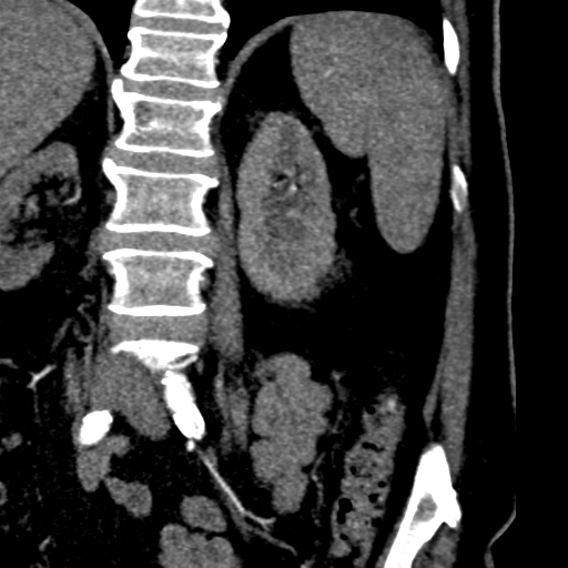 File:Bilateral delayed nephrogram from renal artery stenosis (Radiopaedia 47681-52362 B 17).png