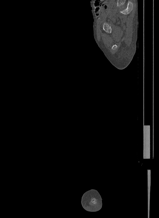 Bilateral fibular hemimelia type II (Radiopaedia 69581-79491 Sagittal bone window 38).jpg