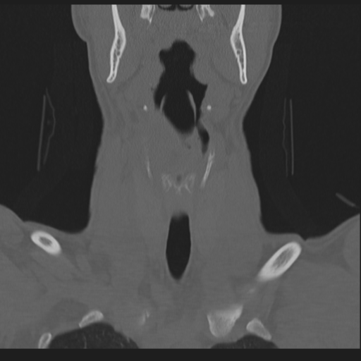 Bilateral locked facets (Radiopaedia 33850-35016 Coronal bone window 26).png