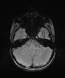 Bilateral mesial temporal polymicrogyria (Radiopaedia 76456-88181 Axial SWI 12).jpg