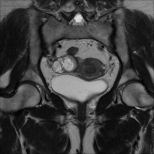 File:Bilateral ovarian dermoid cysts (Radiopaedia 90152-107338 Coronal T2 16).jpg