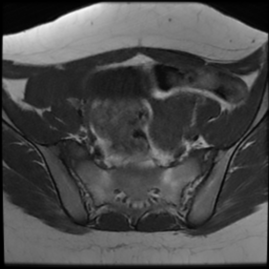 File:Bilateral ovarian fibrothecomas - adolescent (Radiopaedia 86604-102707 Axial T1 10).jpg