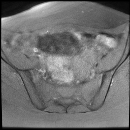 File:Bilateral ovarian fibrothecomas - adolescent (Radiopaedia 86604-102707 Axial T1 fat sat 11).jpg