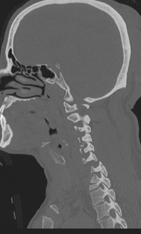 Bilateral perched facet joint (Radiopaedia 63149-71669 Sagittal bone window 12).jpg