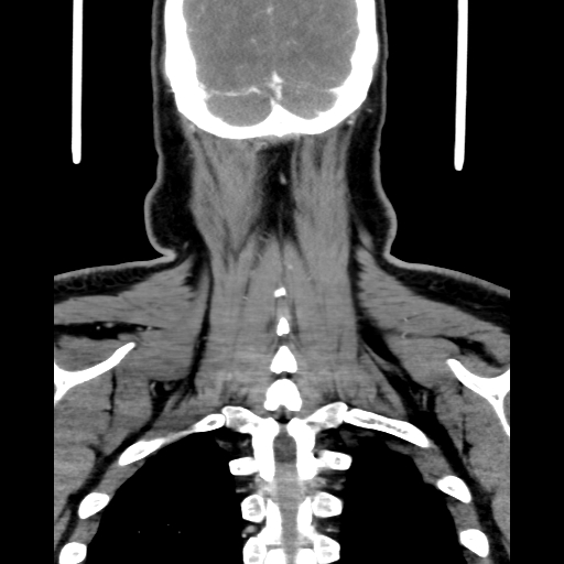 Bilateral peritonsillar abscess (Radiopaedia 85065-100610 Coronal 63).jpg