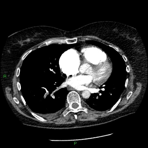 Bilateral pulmonary emboli (Radiopaedia 32700-33669 Axial C+ CTPA 65).jpg
