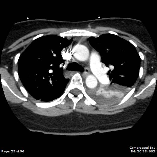 Bilateral pulmonary emboli with Hampton hump sign (Radiopaedia 54070-60246 Axial C+ CTPA 26).jpg