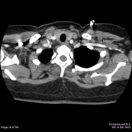 Bilateral pulmonary emboli with Hampton hump sign (Radiopaedia 54070-60246 Axial C+ CTPA 5).jpg