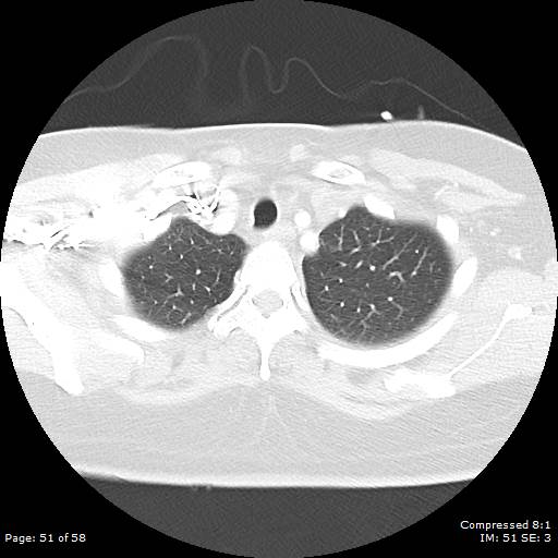 Bilateral pulmonary emboli with Hampton hump sign (Radiopaedia 54070-60246 Axial lung window 51).jpg