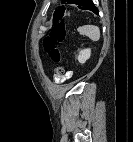 File:Bilateral rectus sheath hematomas (Radiopaedia 50778-56252 B 68).jpg