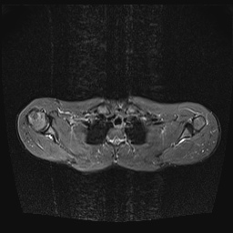 File:Bilateral spinoglenoid notch ganglion cysts (Radiopaedia 29577-30082 E 8).jpg