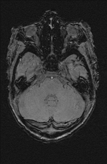 Bilateral subdural hemorrhage and parietal skull fracture (Radiopaedia 26058-26190 Axial SWI 16).png